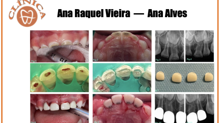 “Reabilitação com coroas de zircónia, num paciente com CPI “ - Caso clínico