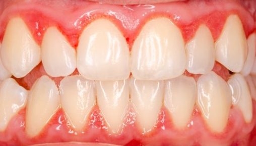 Novo teste caseiro para gengivite protege a saúde oral