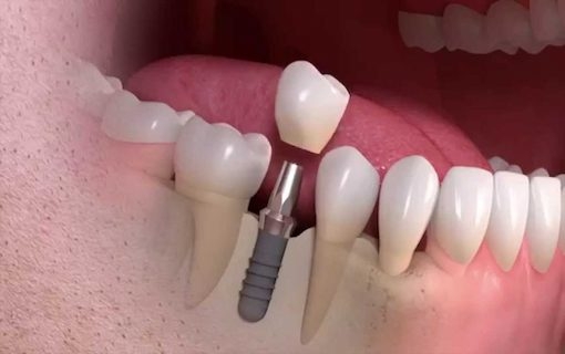 Pessoas alérgicas à penicilina menos propensos a ter implantes dentários bem sucedidos