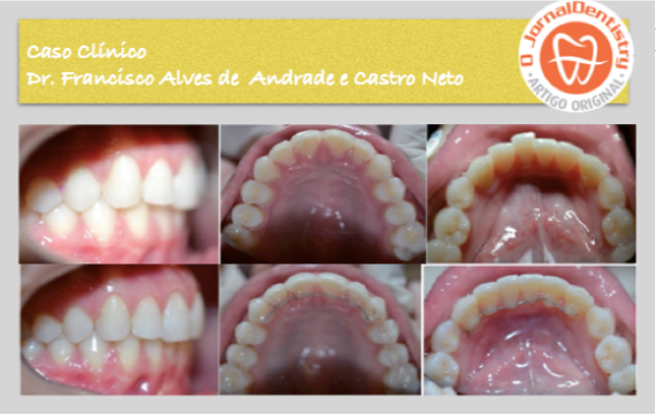 Sistema Art Aligner de Alinhadores invisíveis: Relato de caso