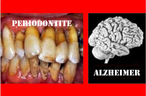 Mais evidências ligam Alzheimer à periodontite