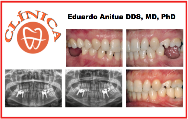 Reabilitação de espaço edêntulo mandibular com reabsorção horizontal de implantes de plataforma estreita e conexão interna. Caso clínico com cinco anos de Follow-Up