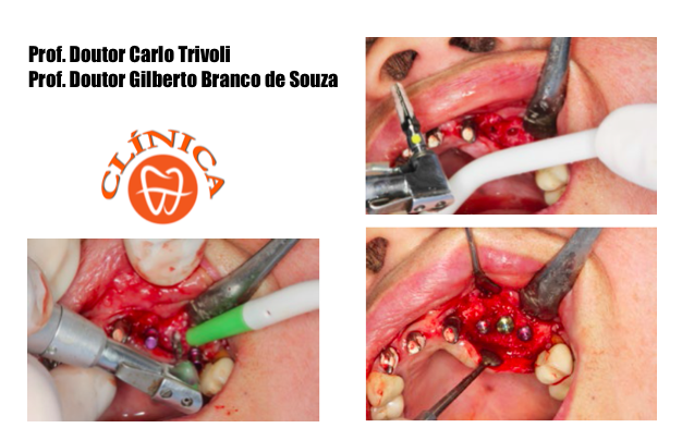 Uso da proteína morfogenética humana recombinante número 2 (BMP2) para aumento vertical de rebordo ósseo - Caso clínico