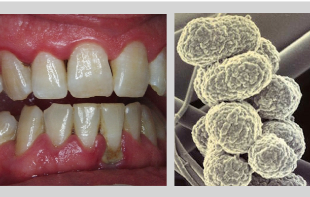 Como a Biocerâmica poderá vir a ajudar o combater à doença gengival grave