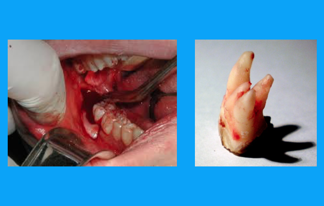 Deve-se extrair o dente do siso se não estiver a causar qualquer dor?