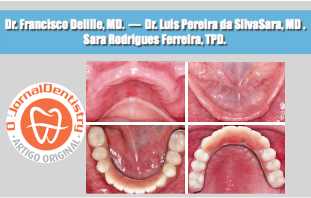 Reabilitação total Bimaxilar com Próteses Híbridas