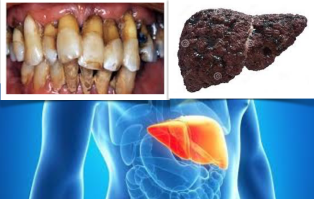 A periodontite severa em doente com cirrose provoca maior mortalidade