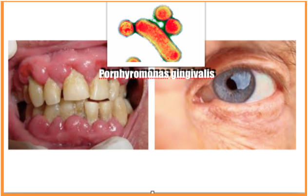 Ligação  entre a inflamação periodontal e a degeneração macular relacionada com a  idade