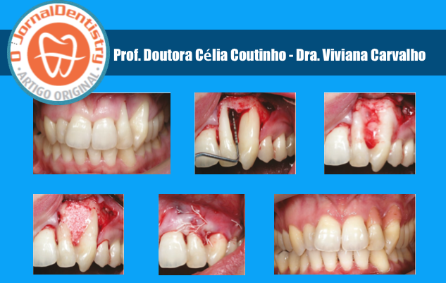 Gestão das Limitações Estéticas após Correção de Defeito Infra-ósseo Periodontal Avançado