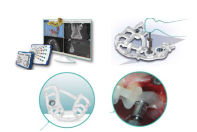 Cirurgia Guiada para um sorriso perfeito!