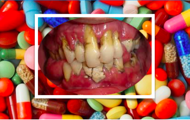 A resistência ao antibióticos está a aumentar em pacientes com doença periodontal grave