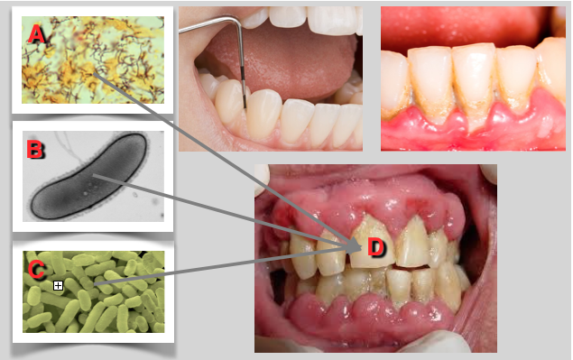 Investigadores mapearam a ecologia microbiana da Gengivite/Periodontite