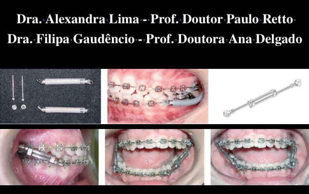 Tratamento da Classe II por Retrusão Mandibular no adulto: Propulsores Mandibulares