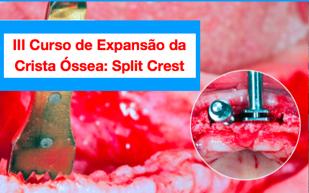 III Curso de Expansão da Crista Óssea: Split Crest