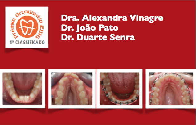 Tratamento de mordida cruzada posterior bilateral com recurso a expansão esquelética e sistema auto-ligável passivo