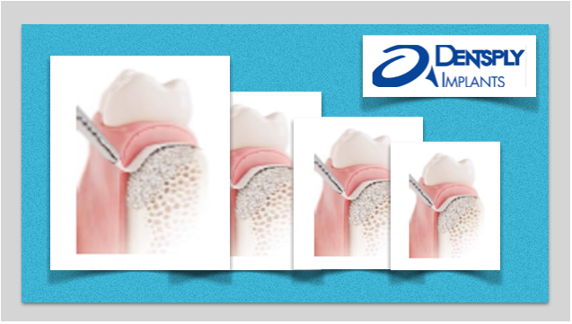 Produtos para regenerações ósseas da Dentsply Implants