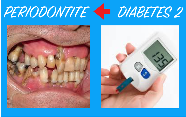 A periodontite pode ser um sinal precoce de diabetes tipo 2