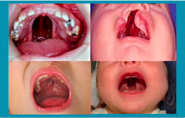 Compreender a sinergia genética da fenda palatina (lábio leporino)