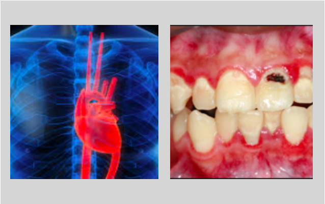 As Infeções dentárias ocultas podem aumentar o risco de doença cardíaca