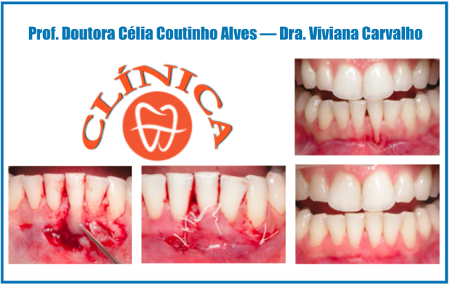 Retalho de rotação lateral no tratamento de recensões gengivas unitárias