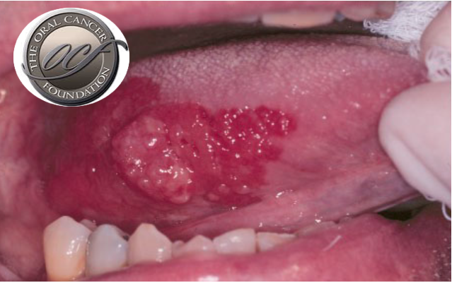 Estudo encontra atividade imunológica anti-inflamatória que favorece os tumores do cancro oral