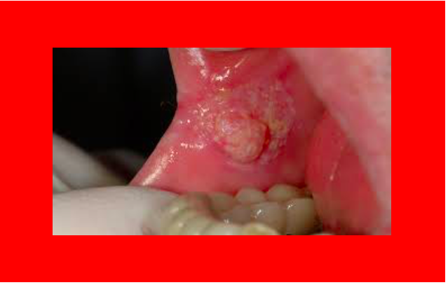 Factos sobre o cancro oral  e da  faringe