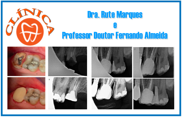 Deep Margin Elevation (DME): Abordagem minimamente invasiva em dentes com margens  profundas