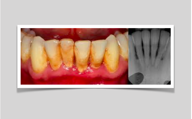 Nova técnica poderá vir a ajudar a regenerar os tecidos destruídos por doença periodontal