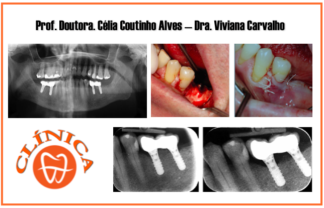 Peri-Implantite: Um possível protocolo cirúrgico de tratamento