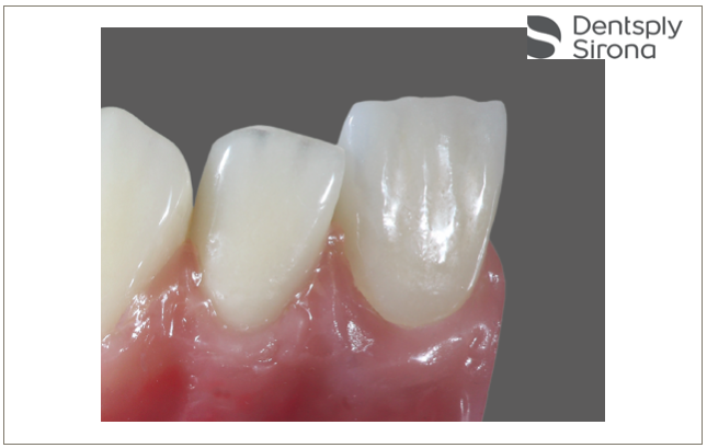 Dentsply Sirona reforça linha  de materiais Cercon