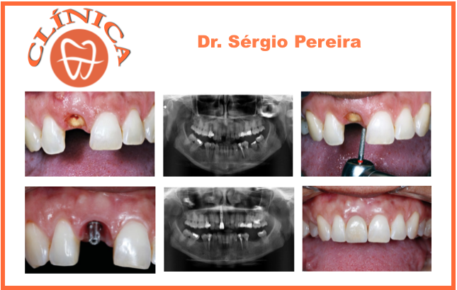 Caso Clínico -  Fratura radicular e infeção com granuloma peri-apical