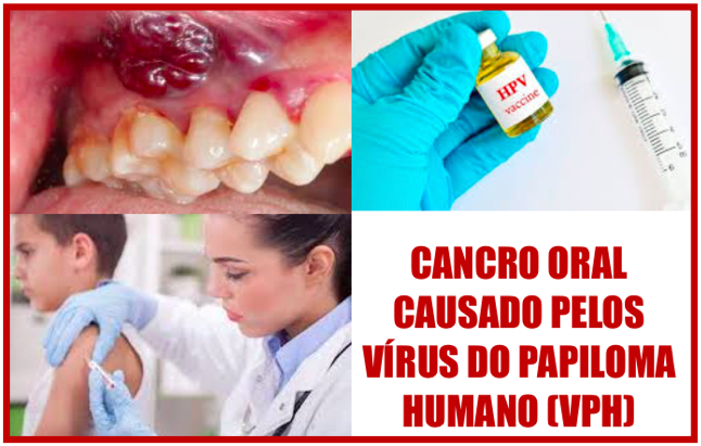 Acordo para vacinação de rapazes contra o VPH no Reino Unido