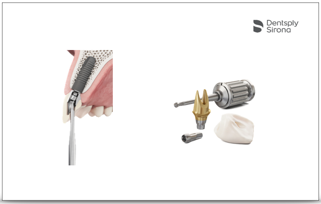 Dentsply Sirona lança nova funcionalidade para Atlantis CustomBase