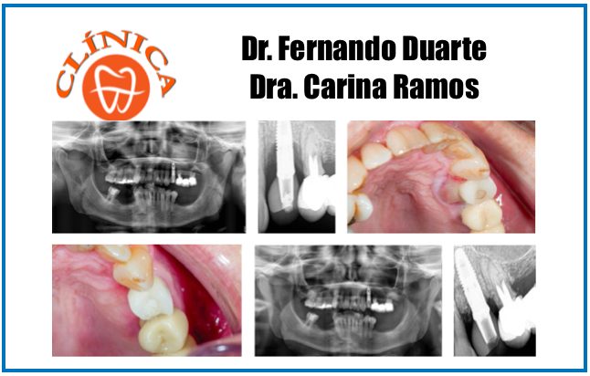 Protocolo IMPLACURE® - Tratamento descontaminante e regenerativo da Peri-Implantite