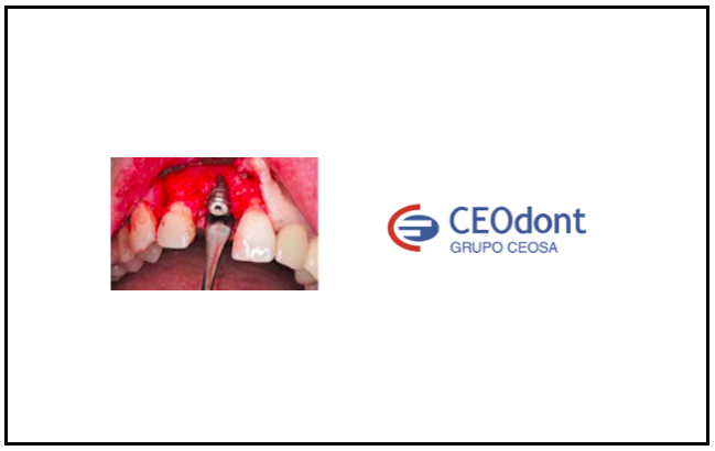 Formação em Cirurgia e Prótese sobre implantes