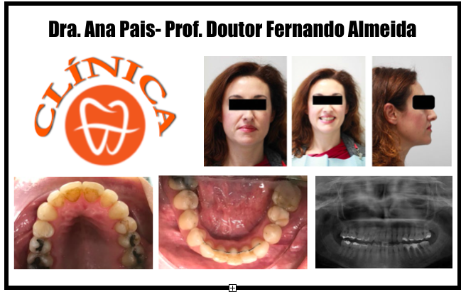 Tratamento da mordida cruzada posterior unilateral num paciente adulto