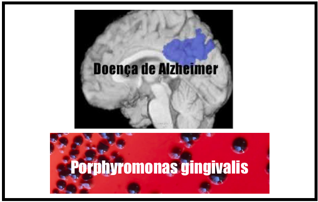 Cientistas encontram  patógeno bacteriano (Porphyromonas gingivalis) em cérebros de pacientes com Alzheimer