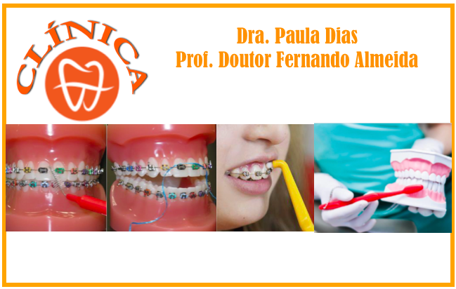 Manutenção da higiene oral em pacientes em tratamento Ortodôntico