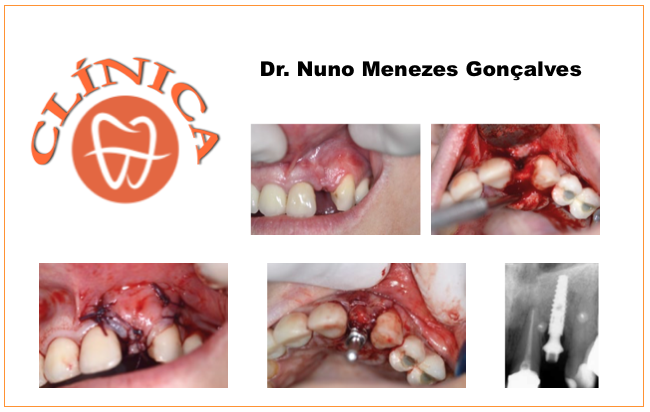 Regeneração óssea guiada com lâmina cortical para aumento da crista óssea alveolar em peri-implantite