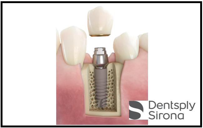 Dentsply Sirona quer revolucionar implantologia com novo Acuris