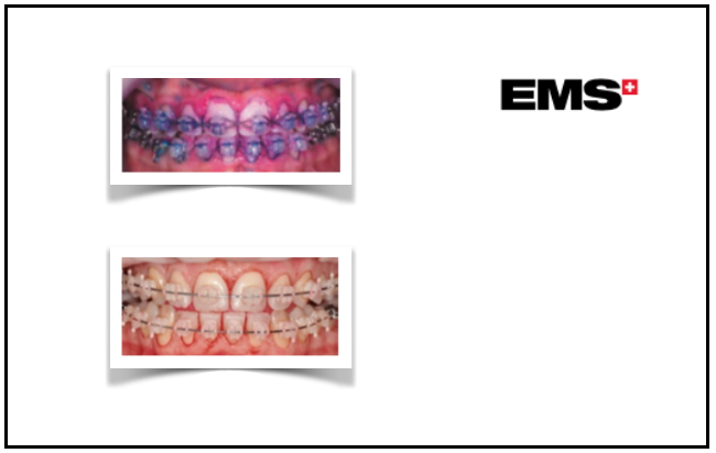 EMS apresenta no SEDO as soluções de higiene oral com  ortodontia