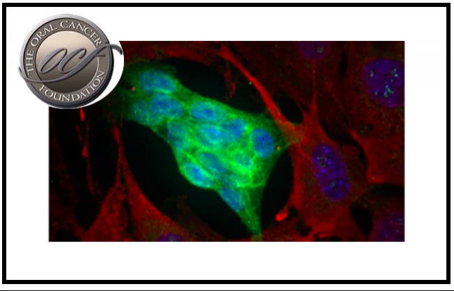 Yale Cancer Center  descobre vulnerabilidades criticas do carcinoma adenoide cístico