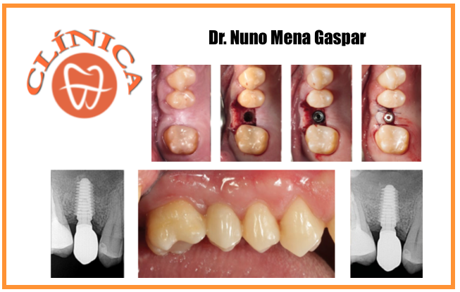 Elevação de seio maxilar com recurso a osseodensificação e colocação de implante dentário: caso clínico