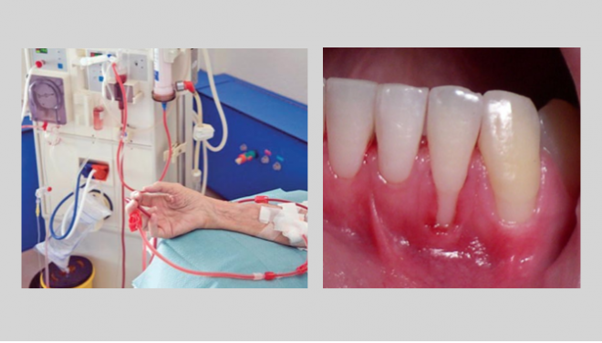 Ligação entre a Periodontite e a  Doença Renal Crónica