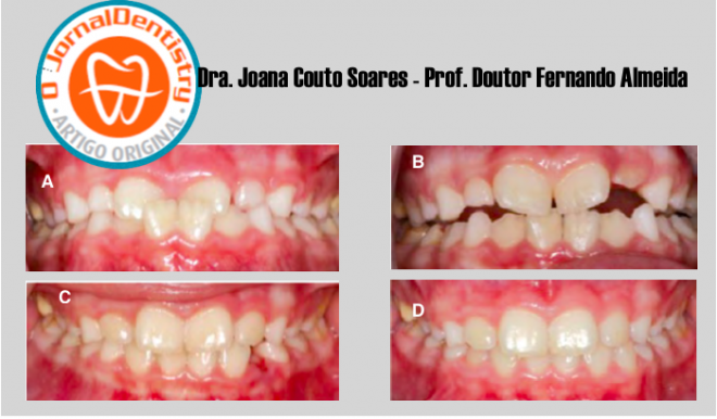 Mordida cruzada anterior — Tratamento com rampas em resina composta: Caso Clínico