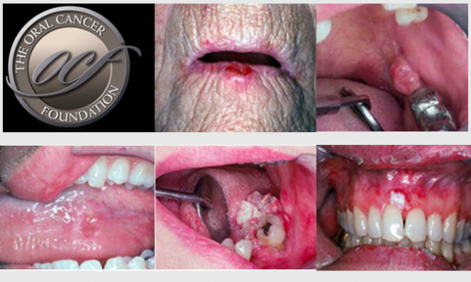 Cancro Oral em imagens - Oral Cancer Foundation