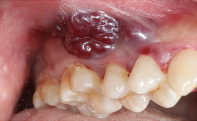 Cirurgia ao cancro da cavidade oral