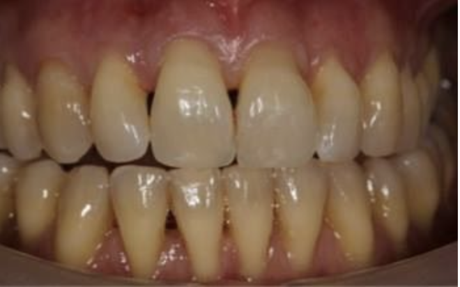 Pessoas que recebem cuidados periodontais têm melhores resultados após ataque cardíaco