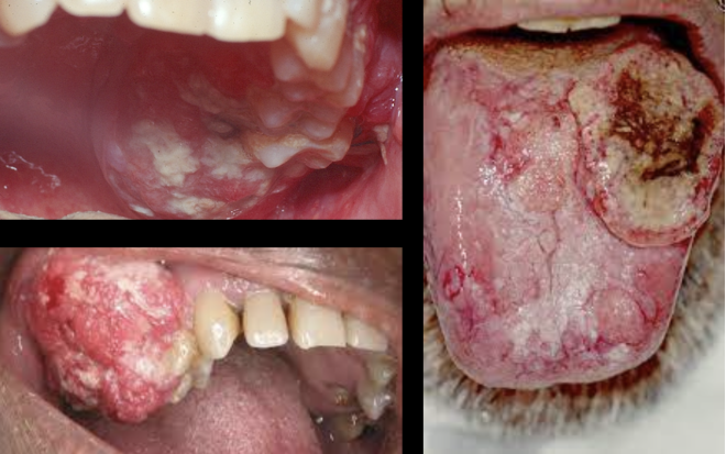 Patogénese e Estratégias de Tratamento Clínico do Cancro Oral