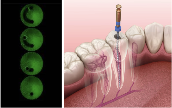 Microrobótica no tratamento endodôntico